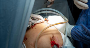 Read more about the article Top 5 Gynaecological Conditions Treated with Laparoscopic Surgery