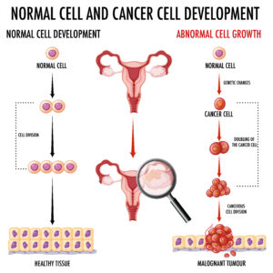 Read more about the article 5 Stages of Ovarian Cancer